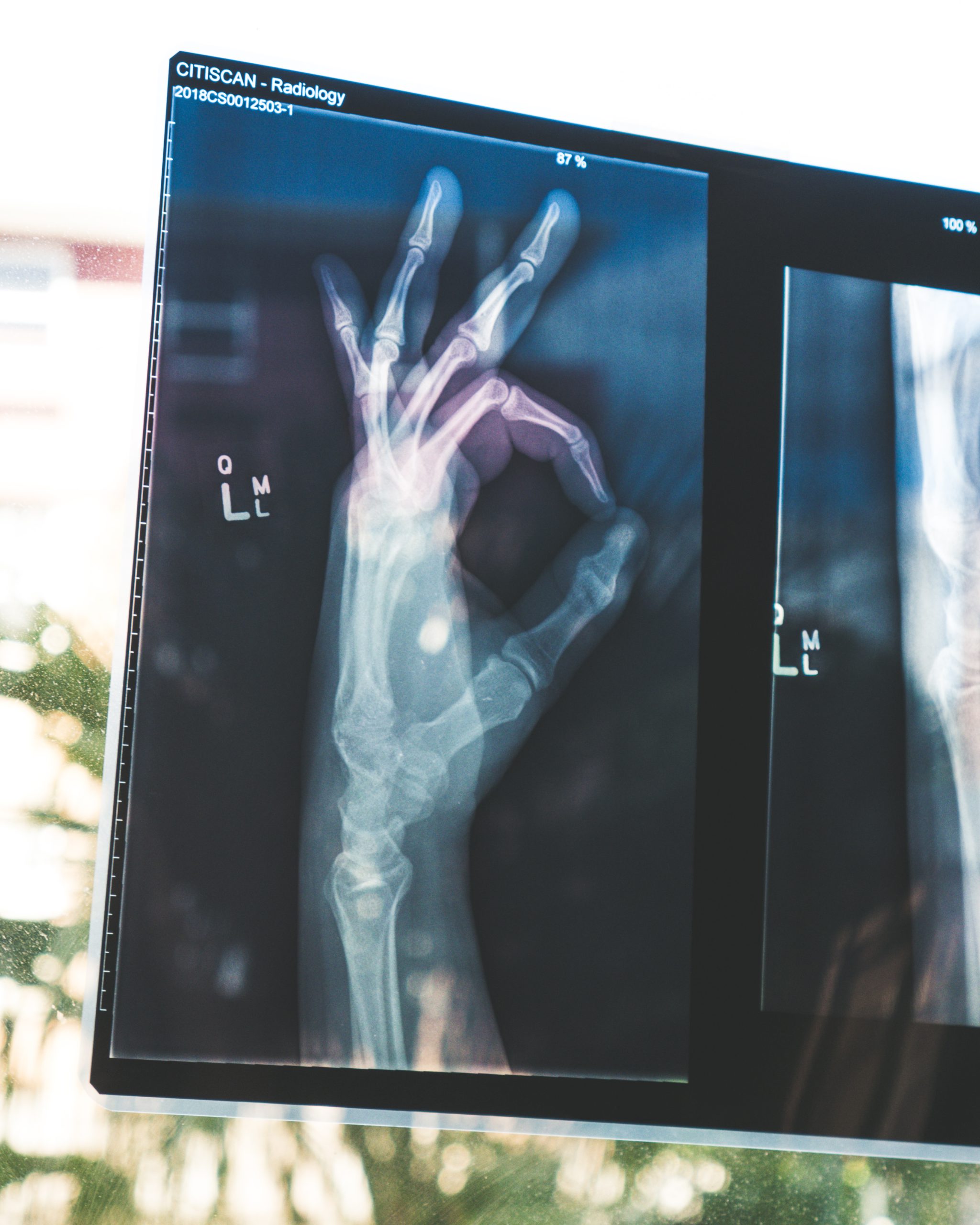 What Does SAMe Do For Joints?